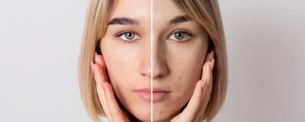 hyperpigmentation